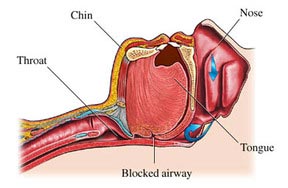 Sleep_Apnea2